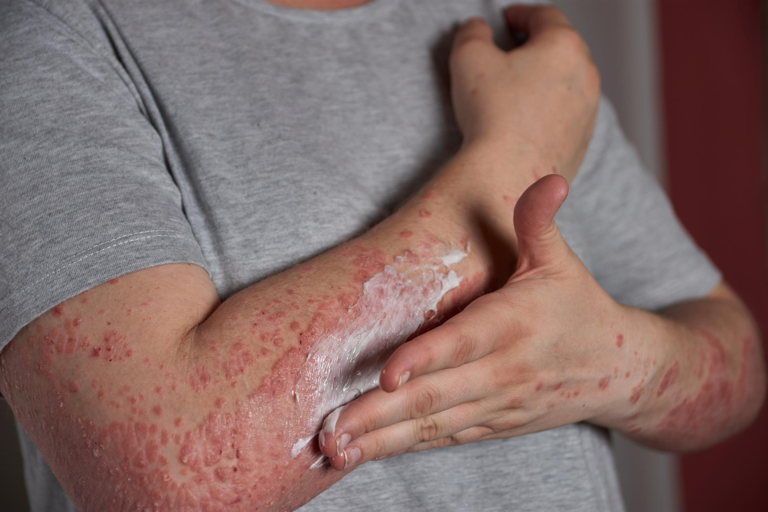 Eczema (3)