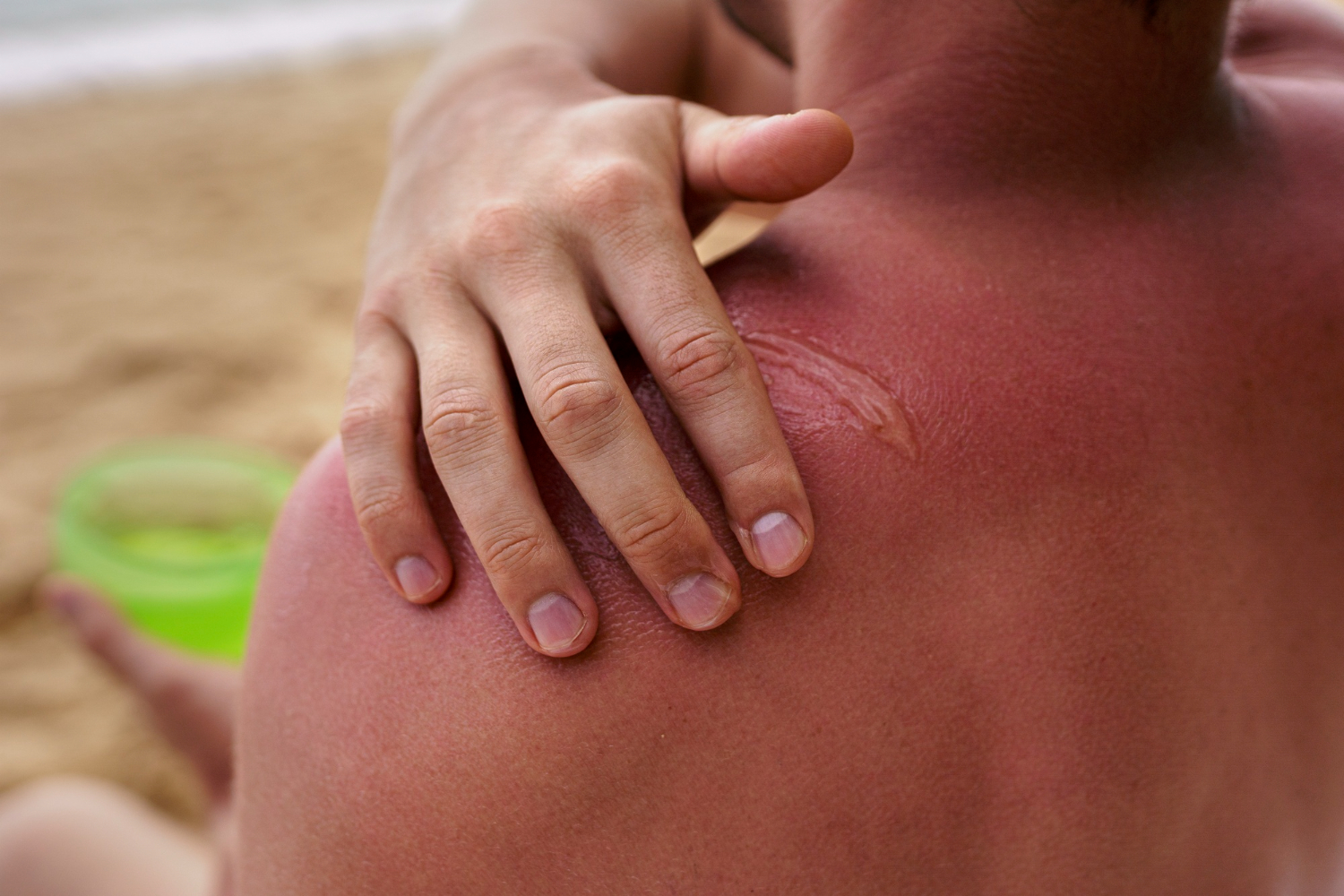 Sunburn