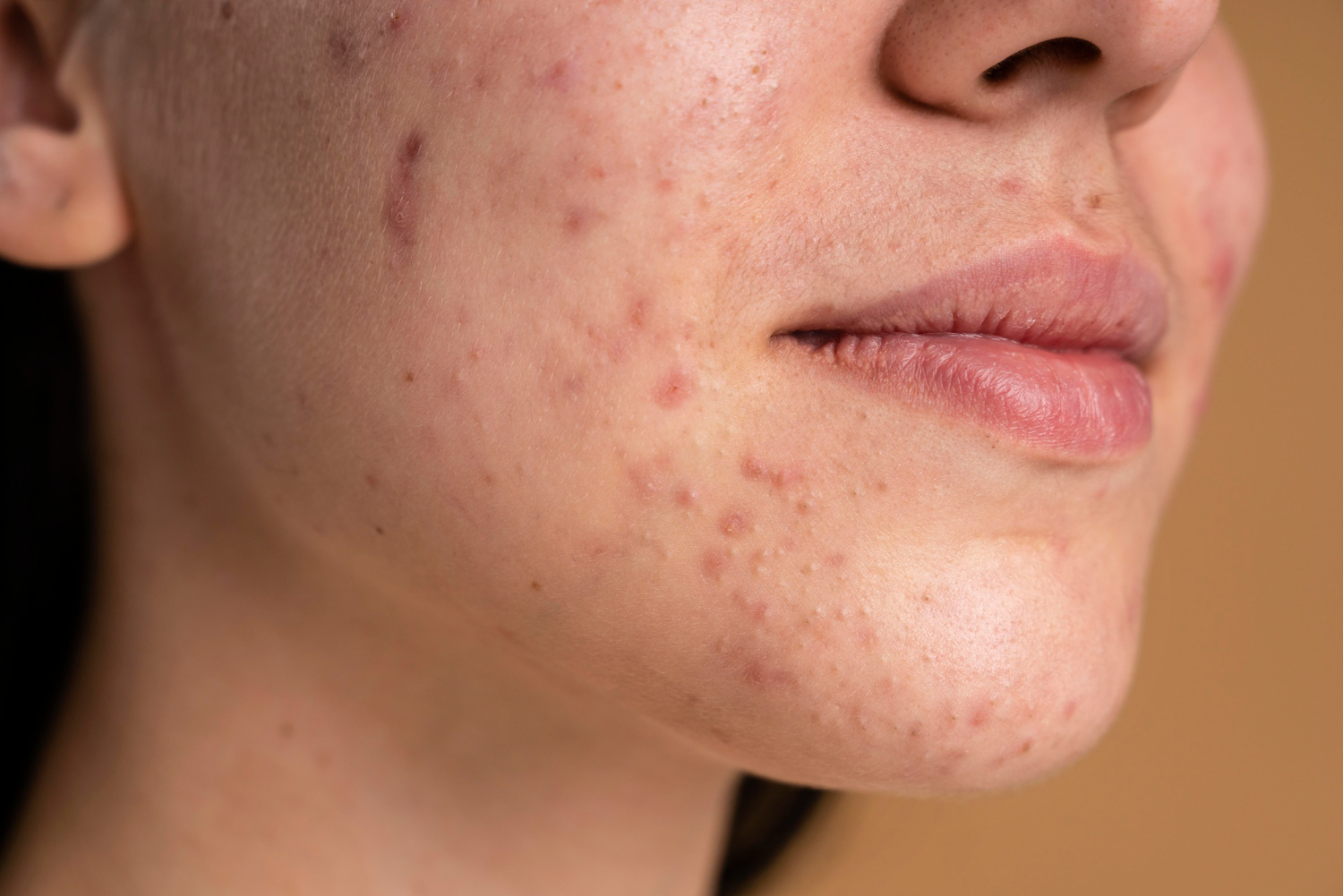 acne (2)