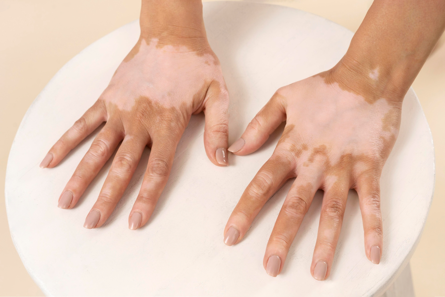 vitiligo